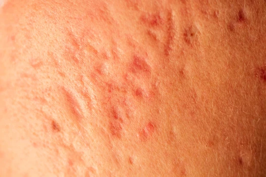 Haut mit Acne Inversa, Nahaufnahme