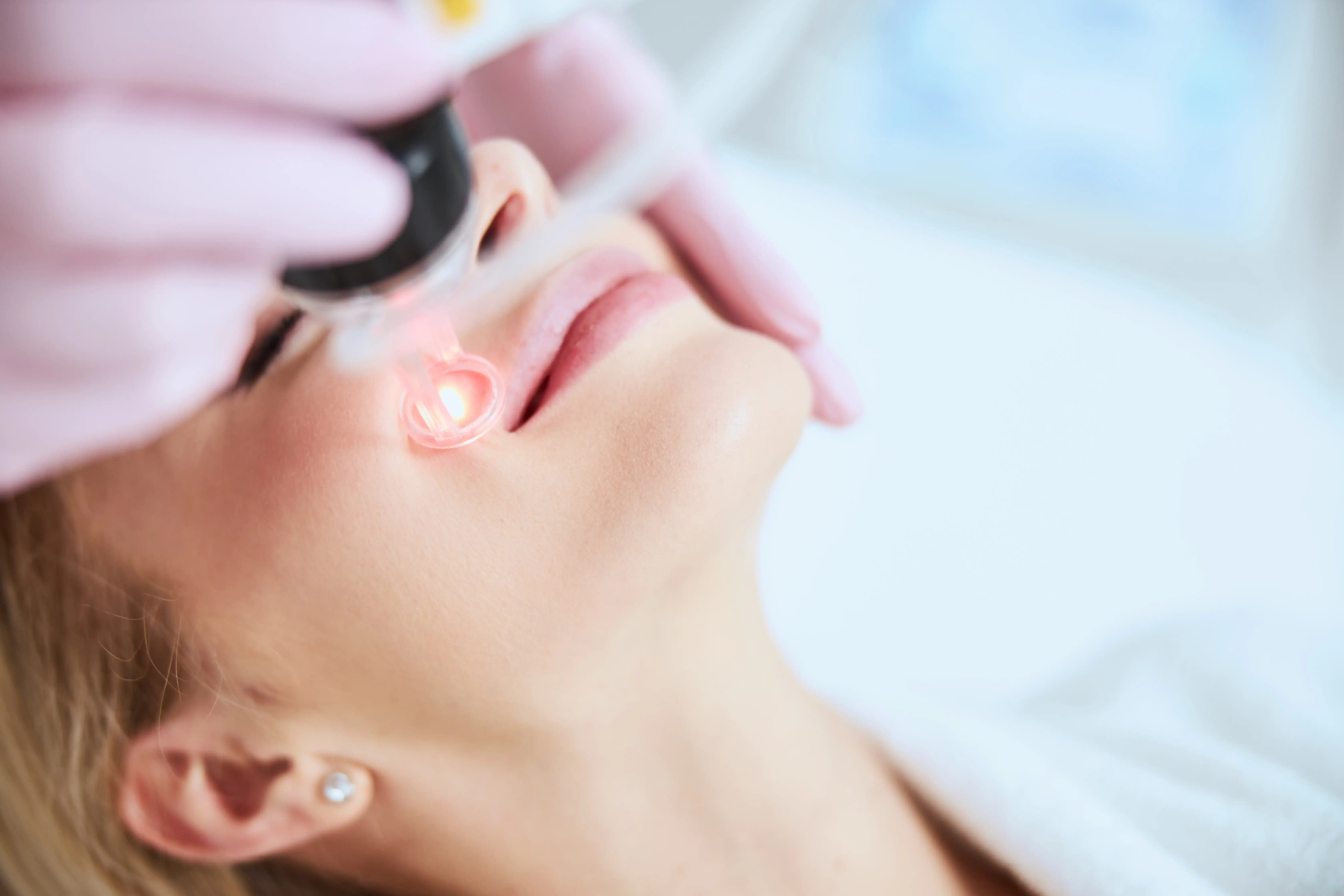 Frau bekommt Laser Behandlung für Rosacea