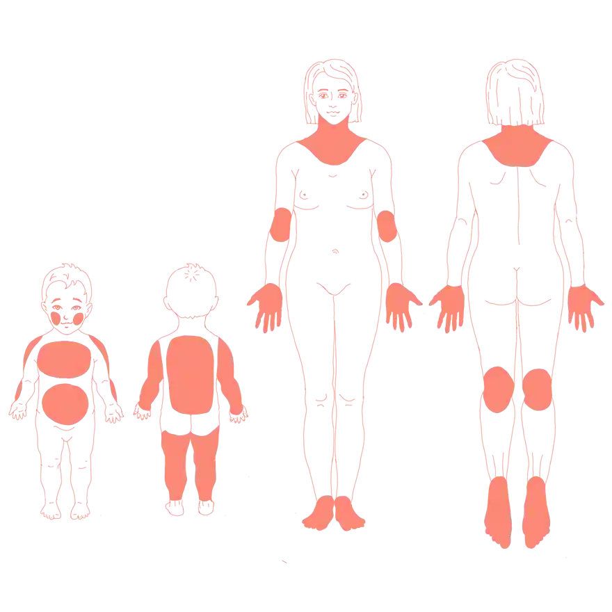 Illustration der betroffenen Hautstellen bei der atopischen Dermatitis (Neurodermitis)