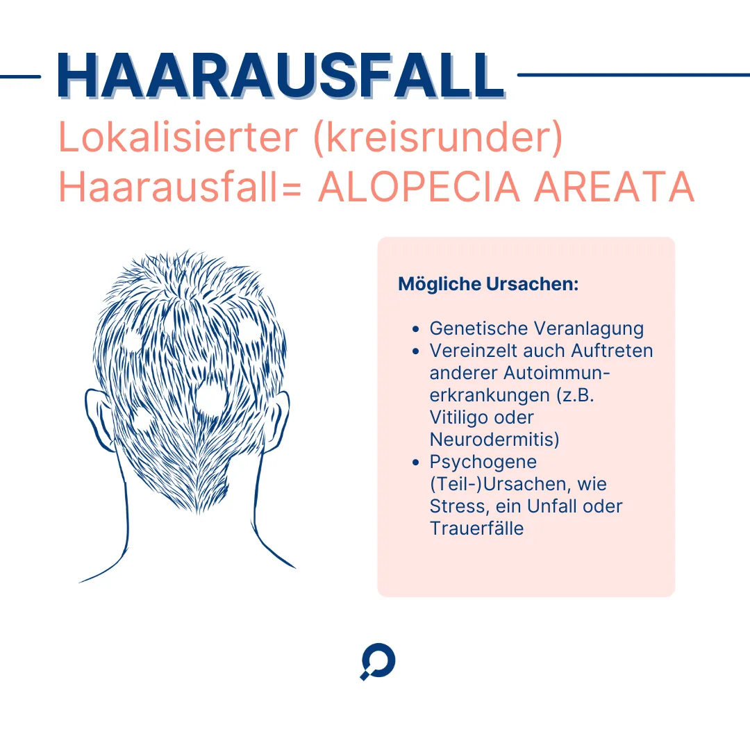 Illustration von lokalem, kreisrundem Haarausfall oder Alopecia Areata