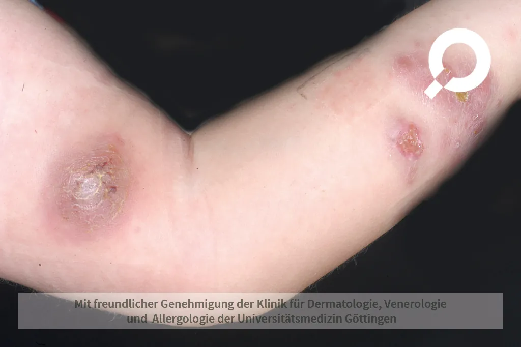 Arm mit Abszess, Furunkel, Eiterbeutel