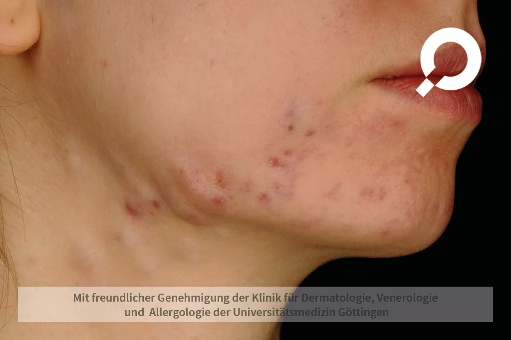 Beispielbild Symptome Abszess