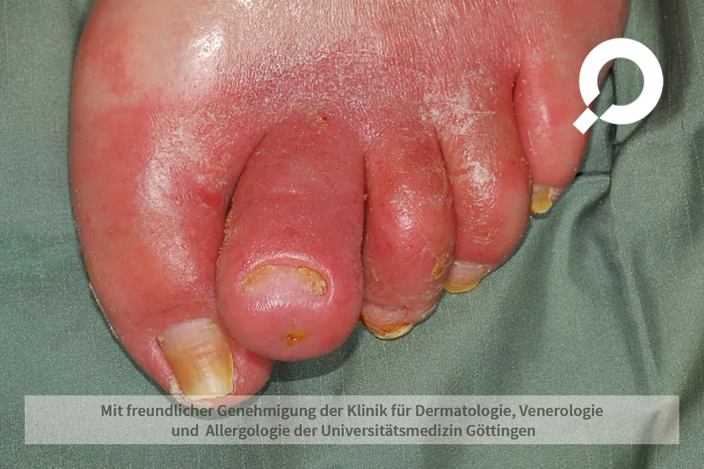 Beispielbild Symptome Abszess