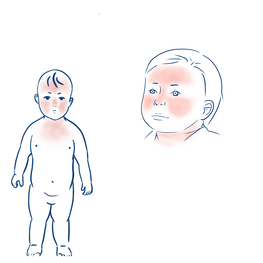 Ausprägung einer Acne Neonatorum im Gesichts und Halsbereich