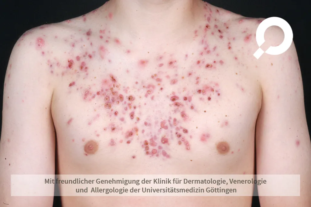 Beispielbild Symptome Akne conglobata