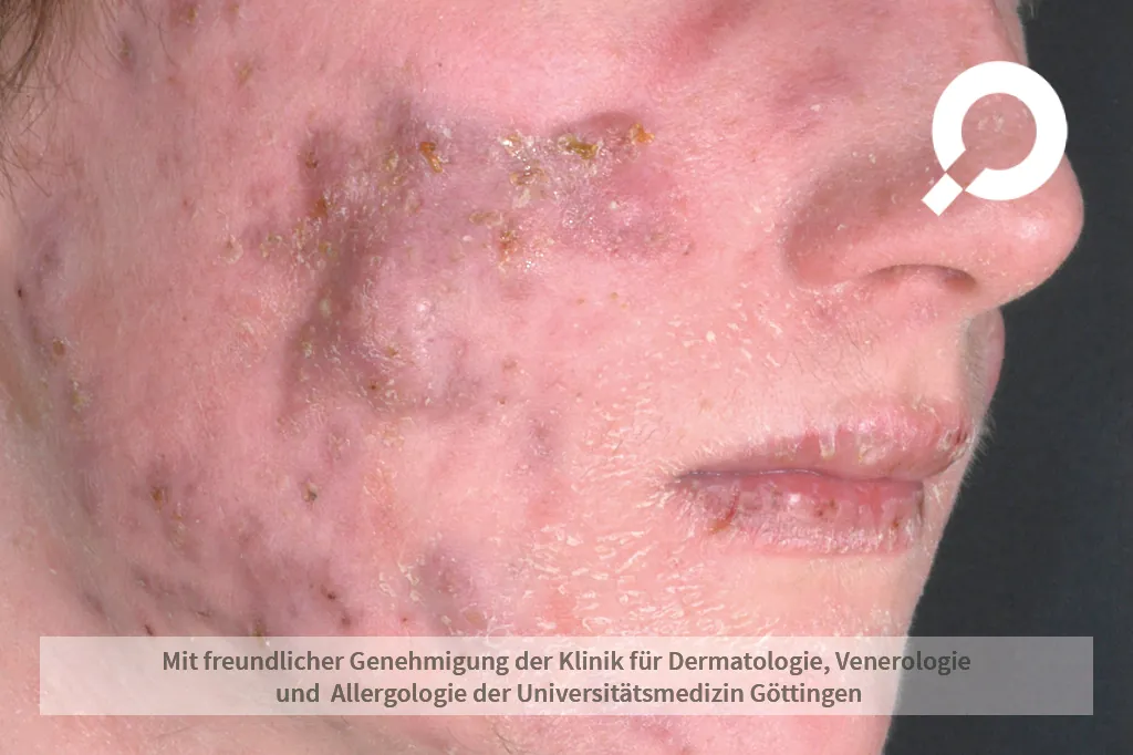 Beispielbild Symptome Akne conglobata