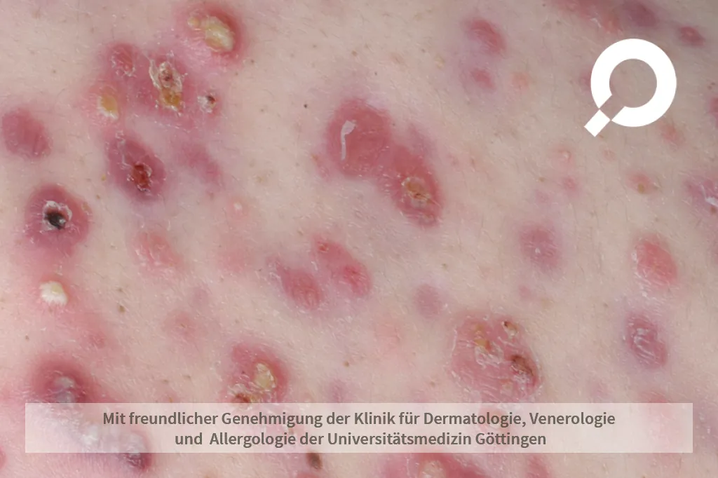 Beispielbild Symptome Akne conglobata