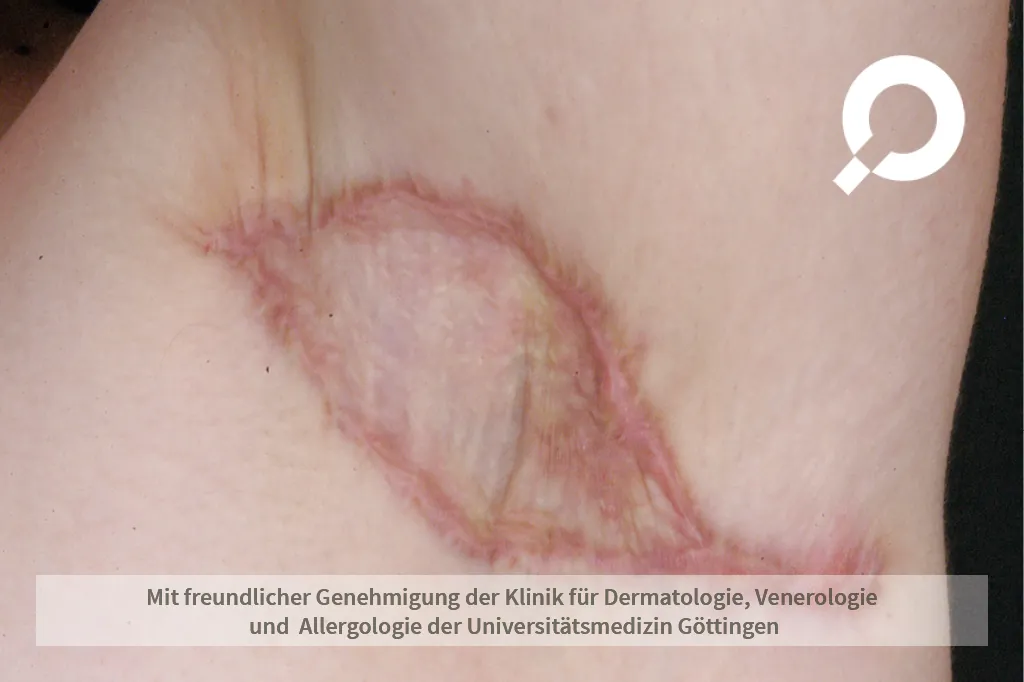 Entzündung entlang der Hautfalte