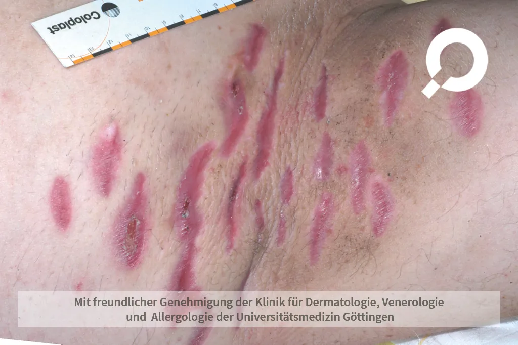 Acne inversa