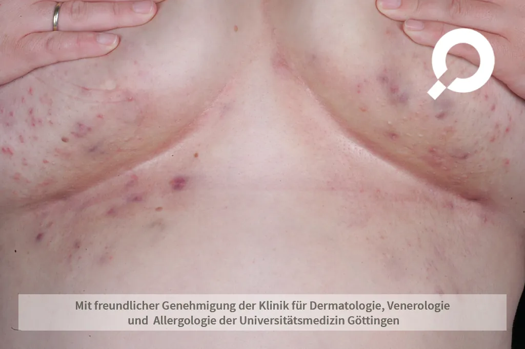 rötlich, blaue Punkte unter der Brust