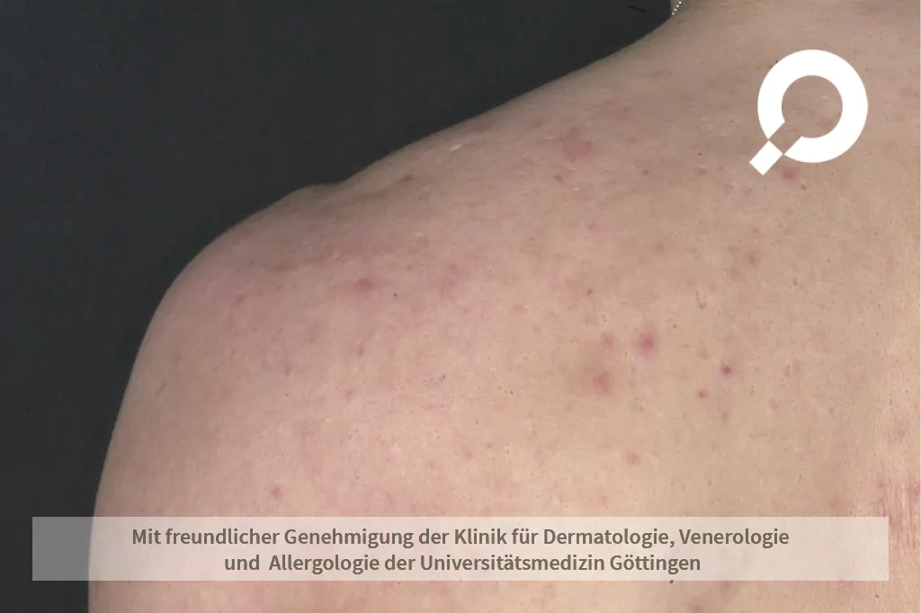 Beispielbild Symptome Akne papulopustulosa