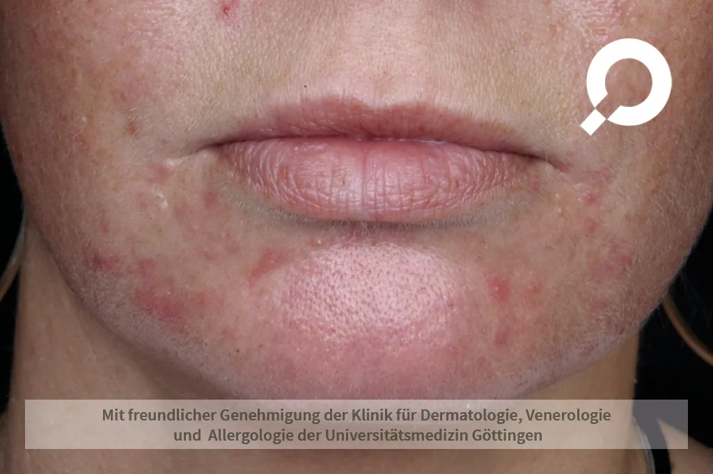 Beispielbild Symptome Akne papulopustulosa