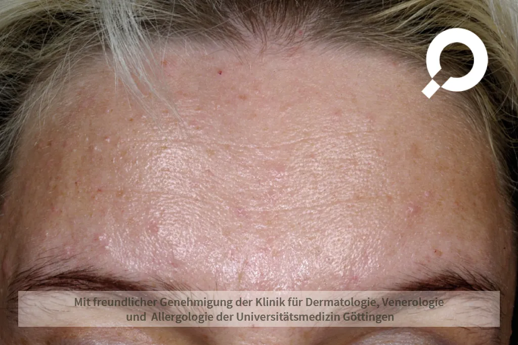 Beispielbild Symptome Akne papulopustulosa