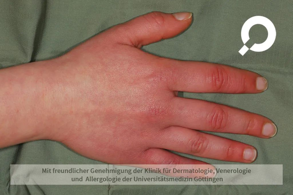 Beispielbild Symptome Akrozyanose