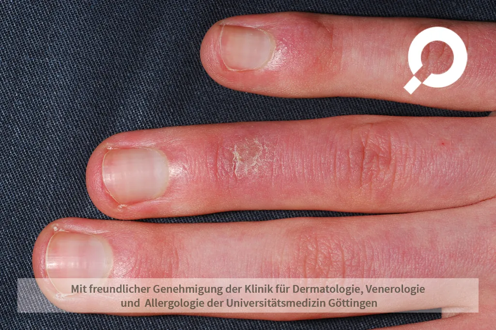 Beispielbild Symptome Akrozyanose