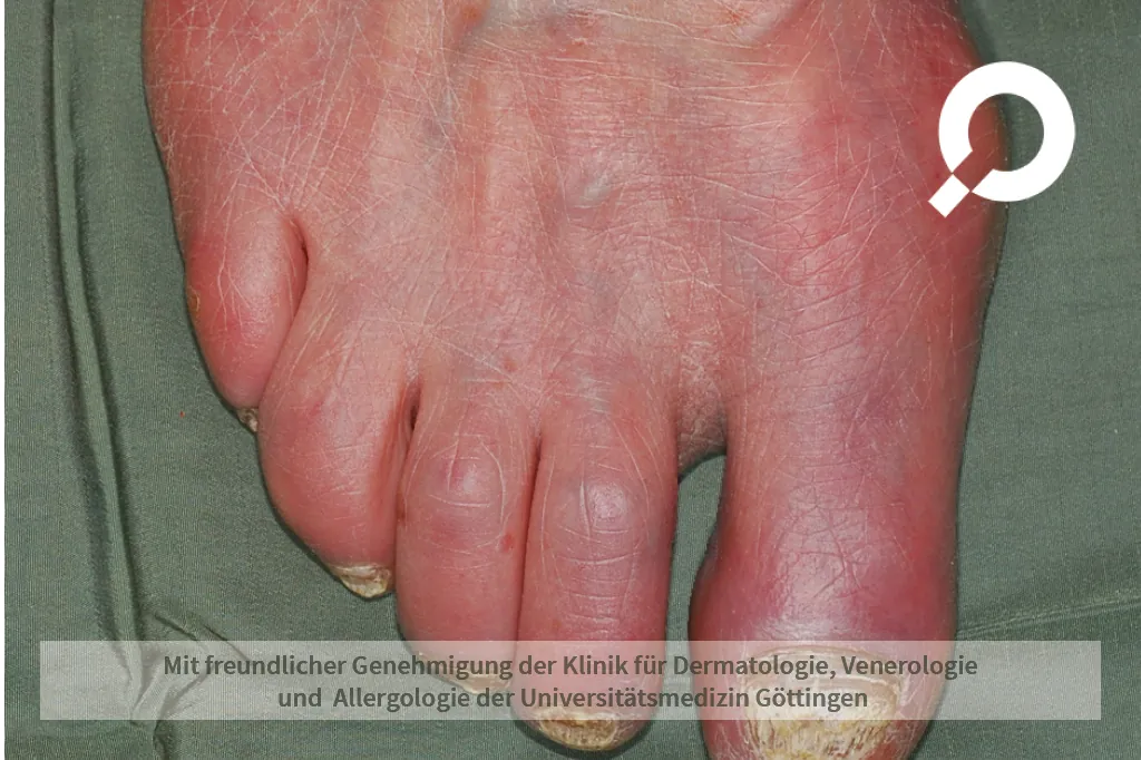 Beispielbild Symptome Akrozyanose