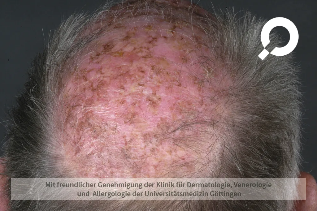 hyperpigmentierung am Kopf