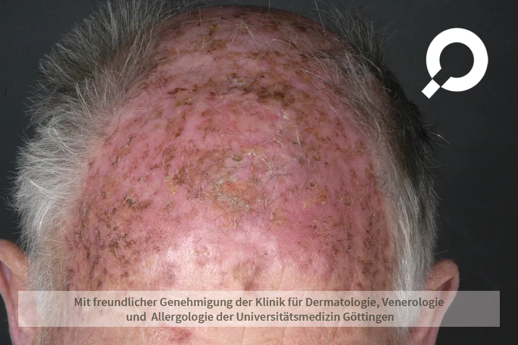 Beispielbild Symptome Aktinische Keratose