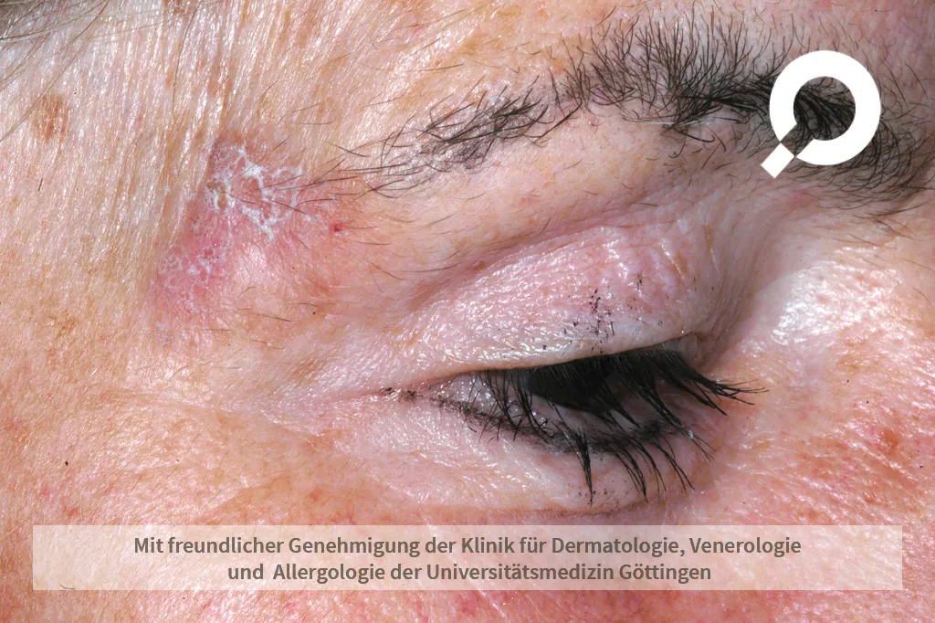 Beispielbild Symptome Aktinische Keratose