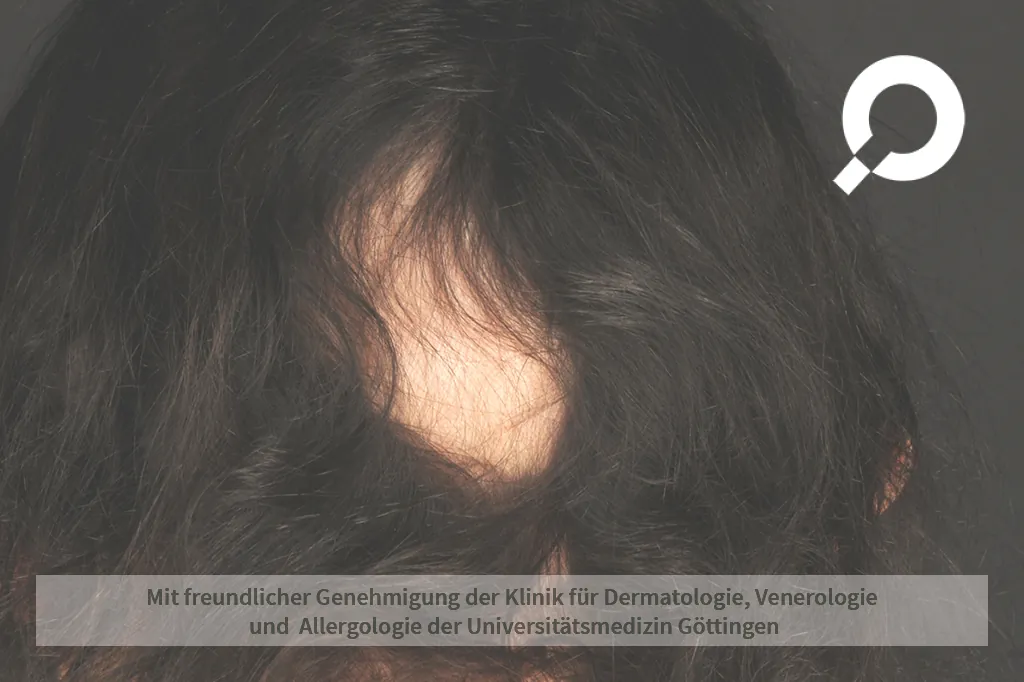 Kreisrunder Haarausfall
