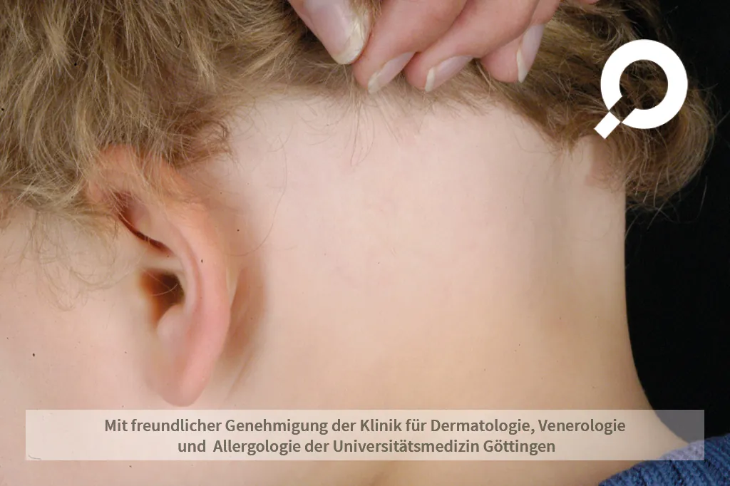 Haarasufall am Hinterkopf