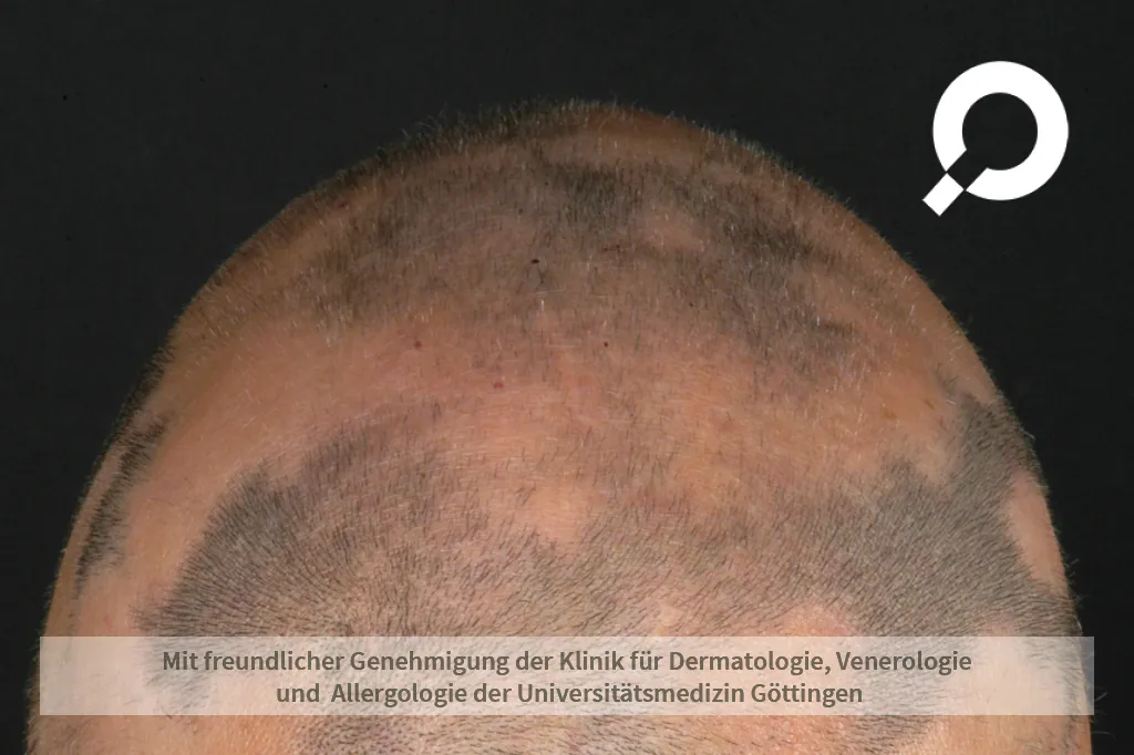 Haarausfall mit Verfärbung