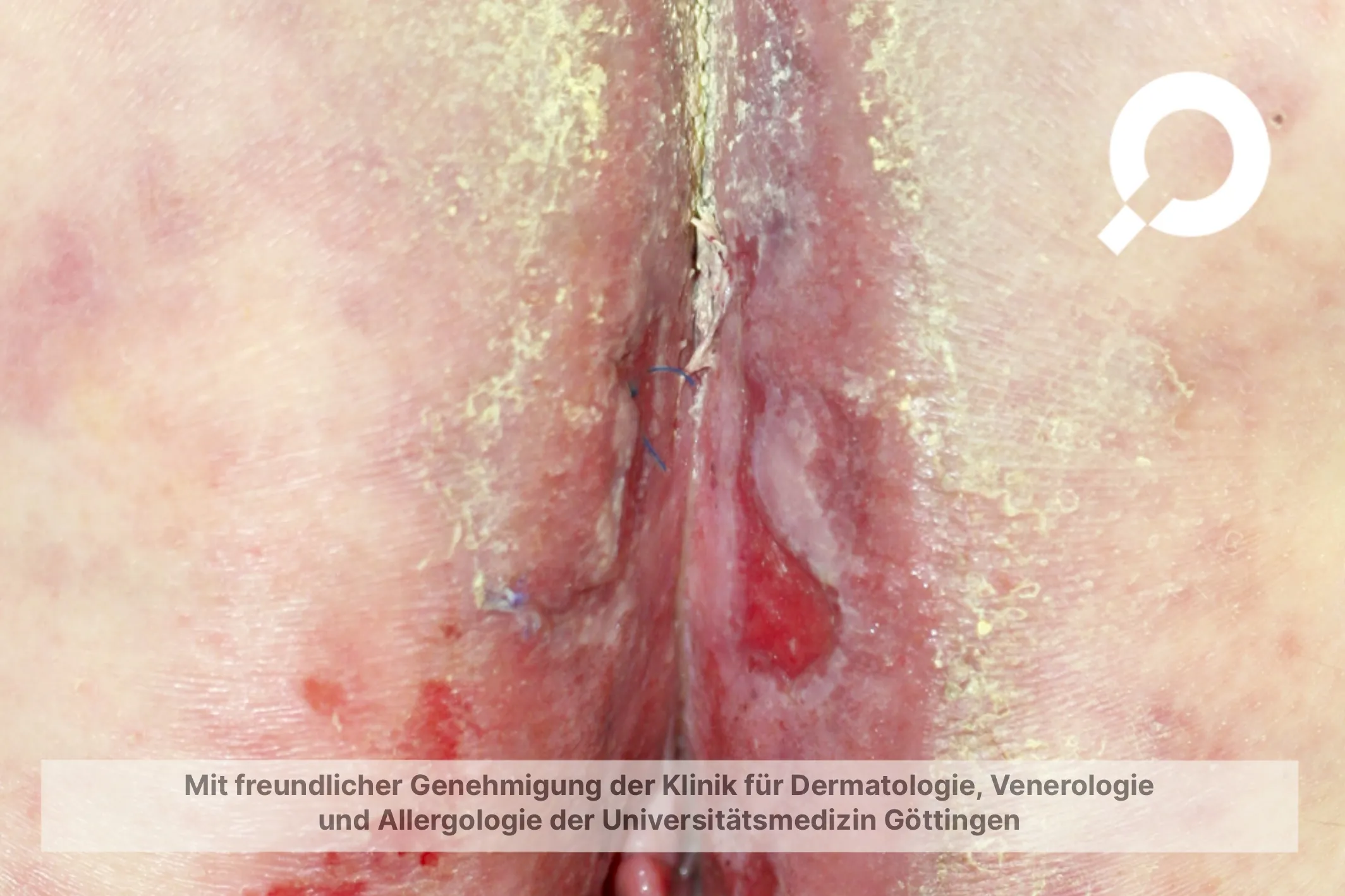 Beispielbild Symptome Analekzem