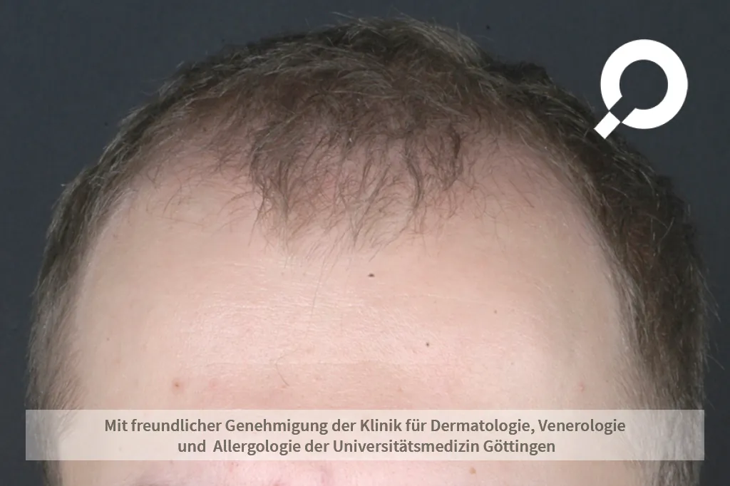 Haarausfall am Haaransatz über den Schläfen