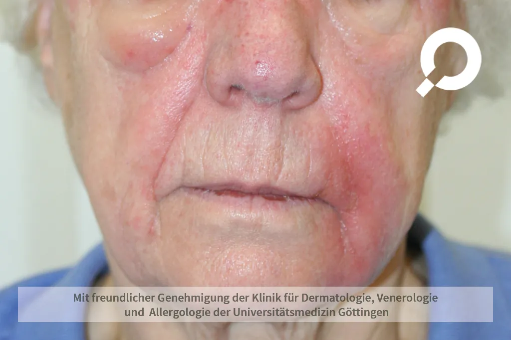 rote Schwellungen im Gesicht