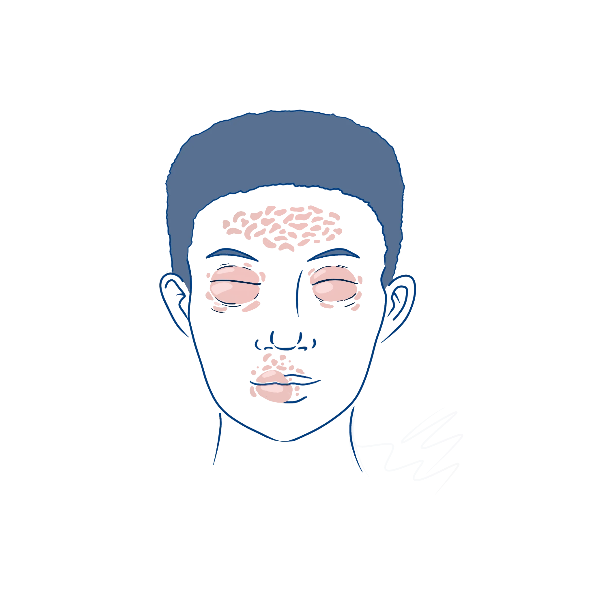 Illustration eines ausgeprägten Angioödem