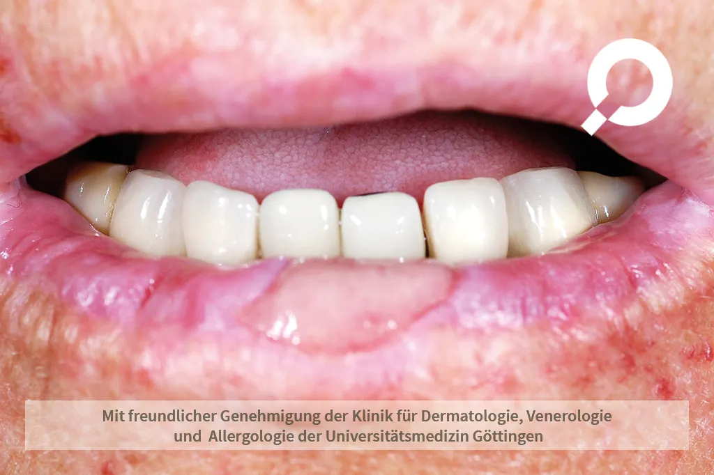 Beispielbild Symptome Aphte