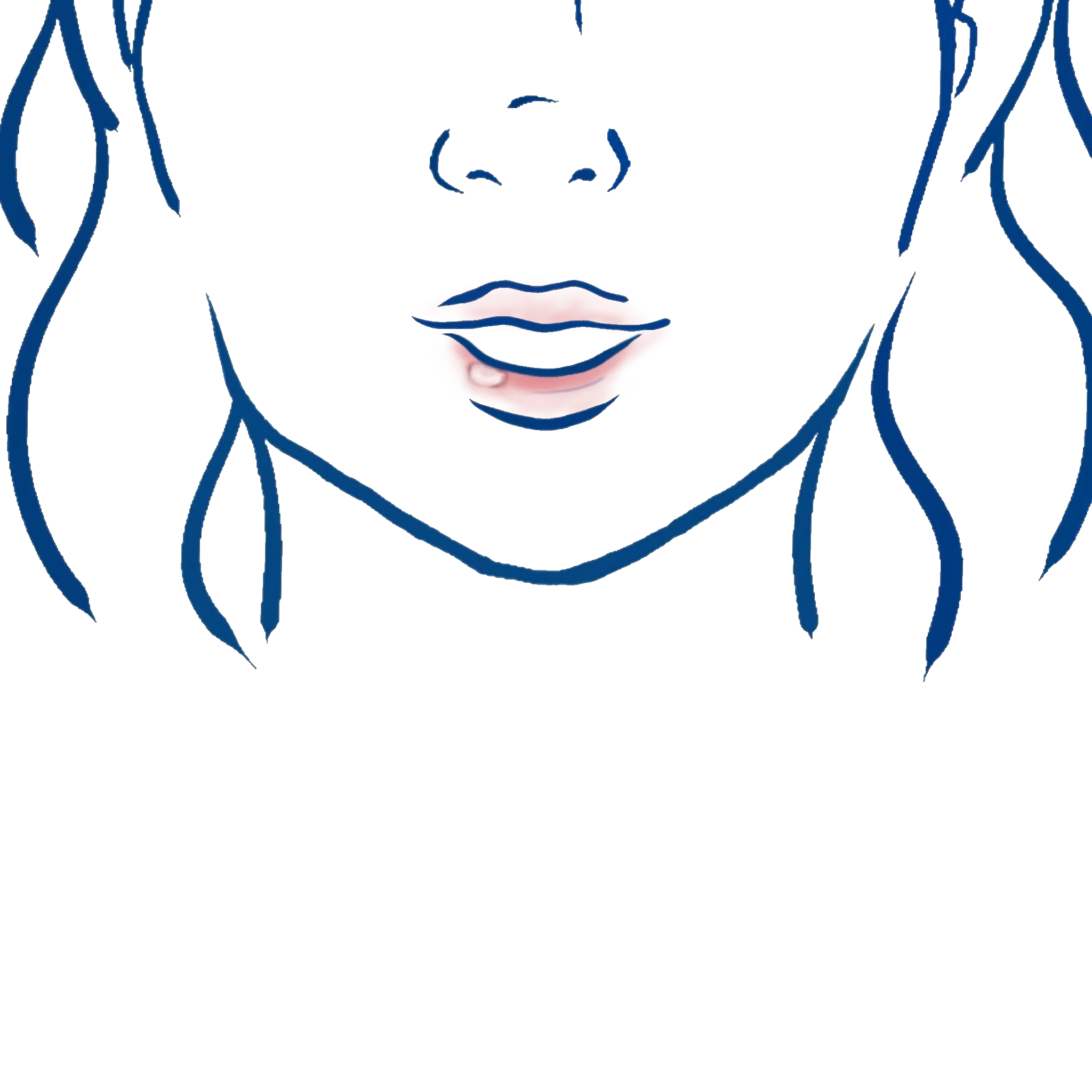 Illustration einer Aphte im Mundbereich