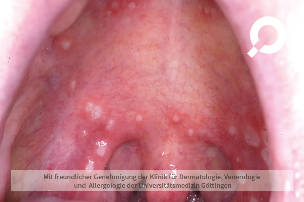 Beispielbild Symptome Aphte