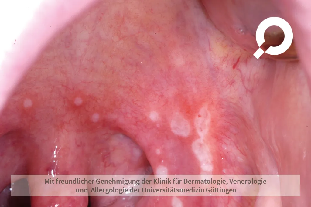 Beispielbild Symptome Aphte