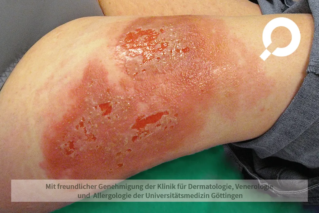 rotes Exanthem blutiger Ausschlag
