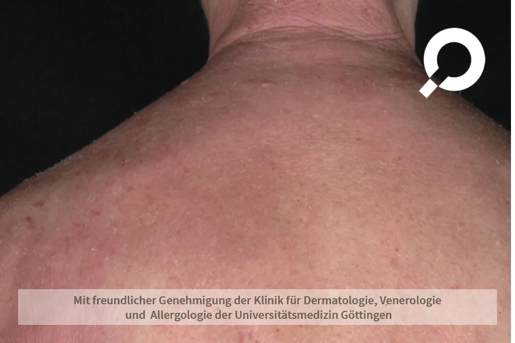 Beispielbild Symptome Atopische Dermatitis Neurodermitis