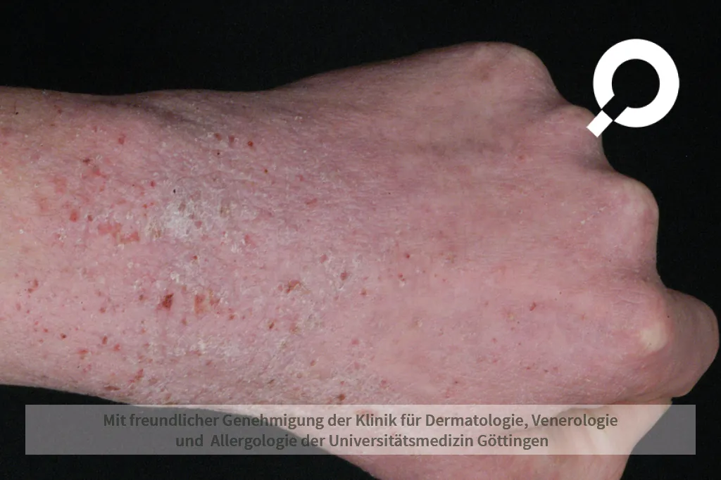Beispielbild Symptome Atopische Dermatitis Neurodermitis