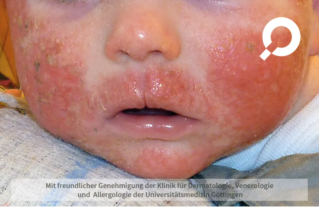 Beispielbild Symptome Atopische Dermatitis Neurodermitis
