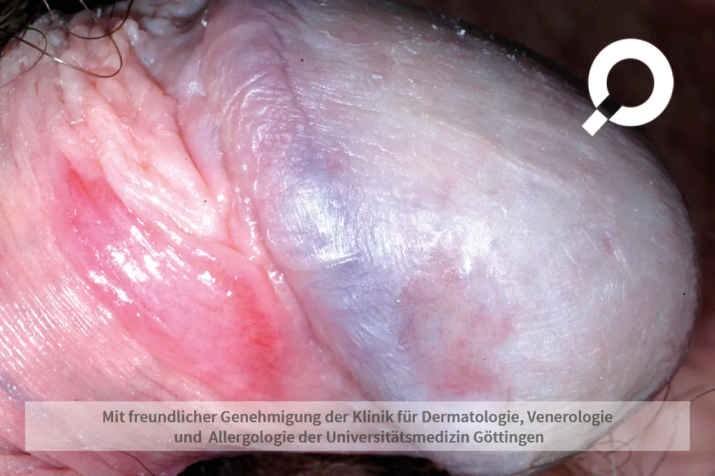 Entzündung an der Eichel