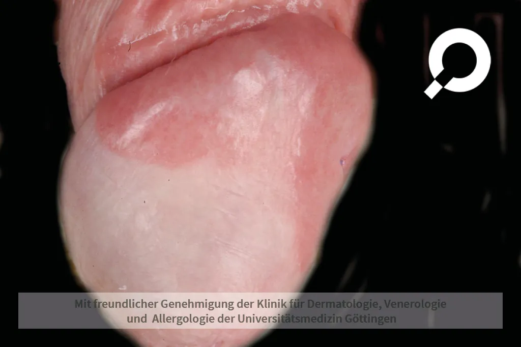 Entzündung an der Eichel