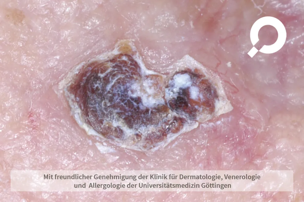 braune Kruste an der Haut