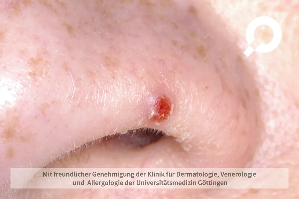 roter Fleck am Nasenflügel