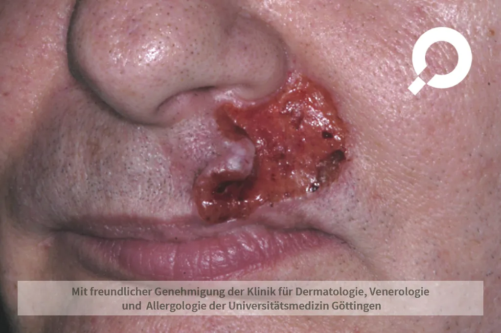 Hautkrebs unter dem rechten Nasenflügel