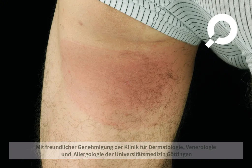 Beispielbild Symptome Borreliose