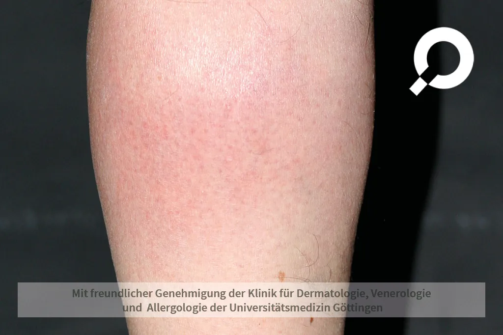 Beispielbild Symptome Borreliose