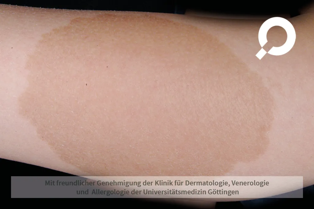 Kaffeartiger Fleck am Bein