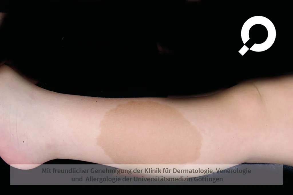Beispielbild Symptome Café-au-lait Flecken