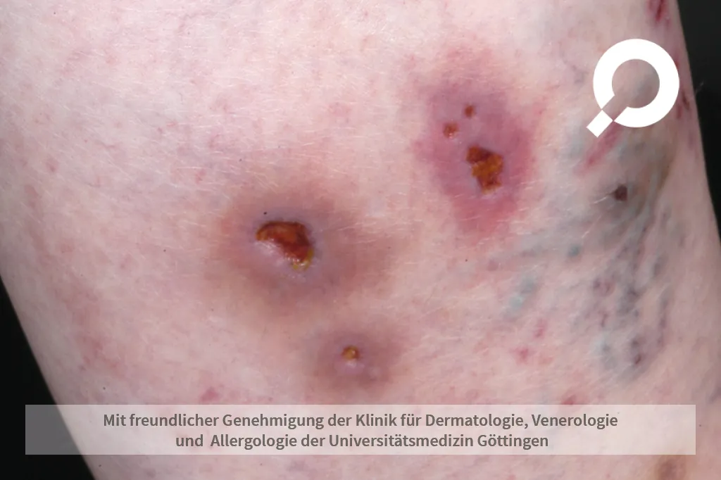 Chronisch Venöse Insuffizienz