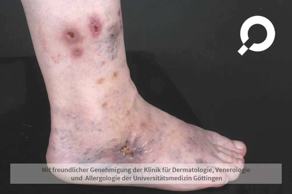 Chronisch Venöse Insuffizienz am Fuß