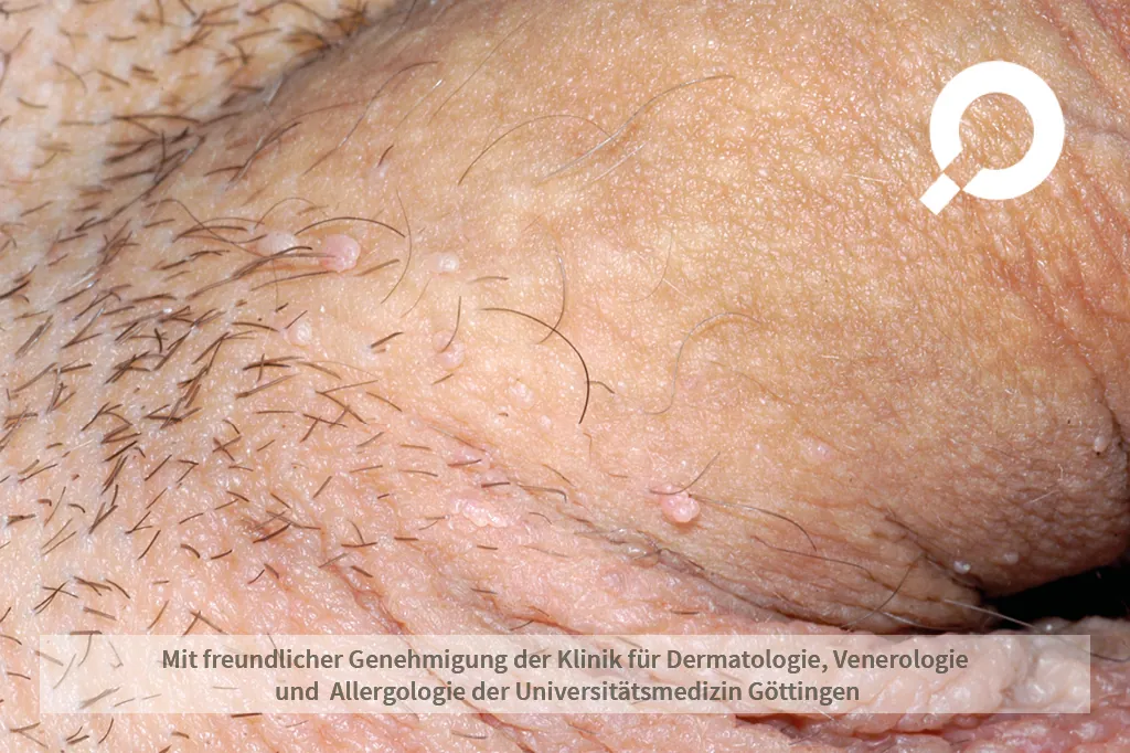 Condylomata acuminata (Kondylome, Feigwarzen)